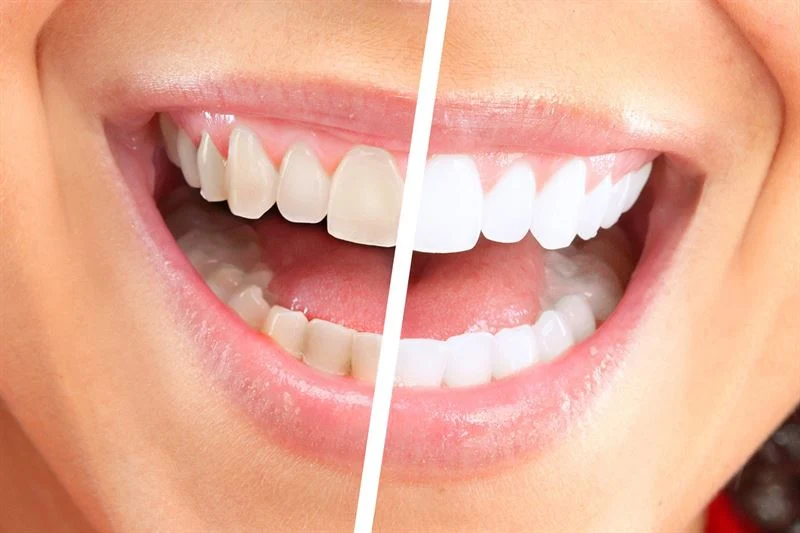 Elektrischer Zahnreiniger und Zahnpolierer SMILE